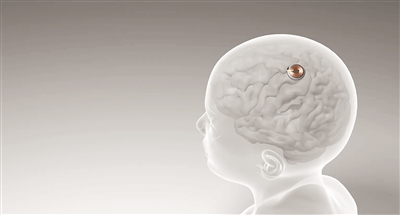 恒行平台：首例脑机接口设备人体移植完成